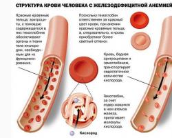 Залізодефіцитна анемія: симптоми і лікування у жінок